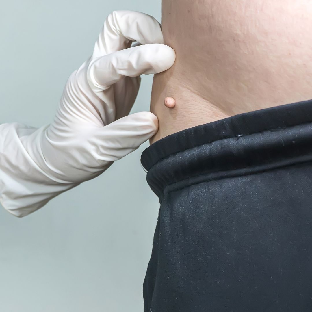Dispelling Common Myths About Skin Tags and Skin Tag Removal