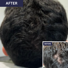 Load image into Gallery viewer, Calecim Advanced Hair System Kit