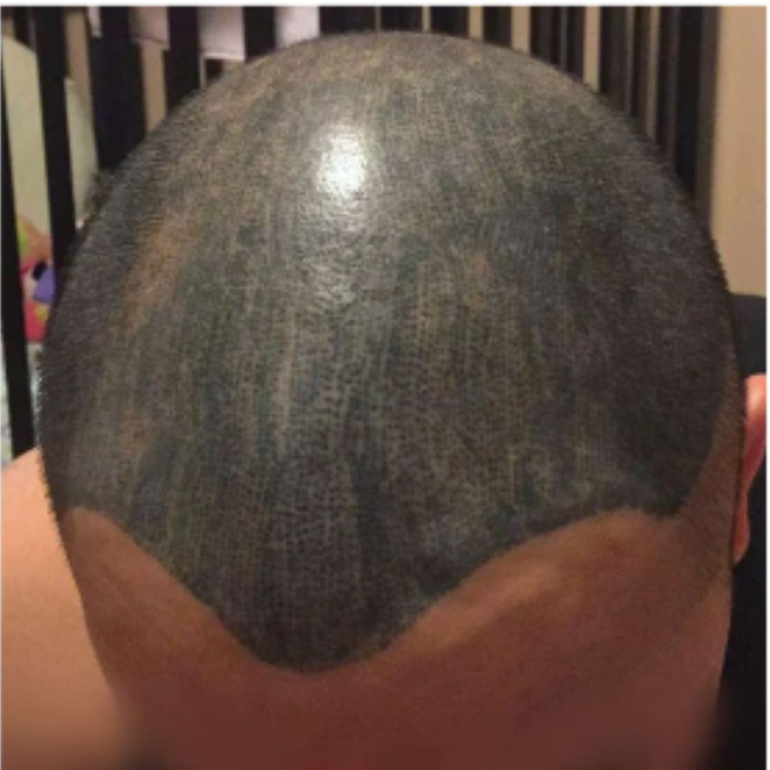 Botched Scalp Micropigmentation 