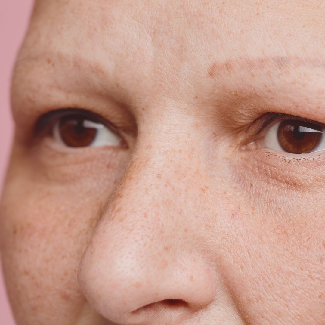 Eyebrow Hair Loss: Causes & Solutions