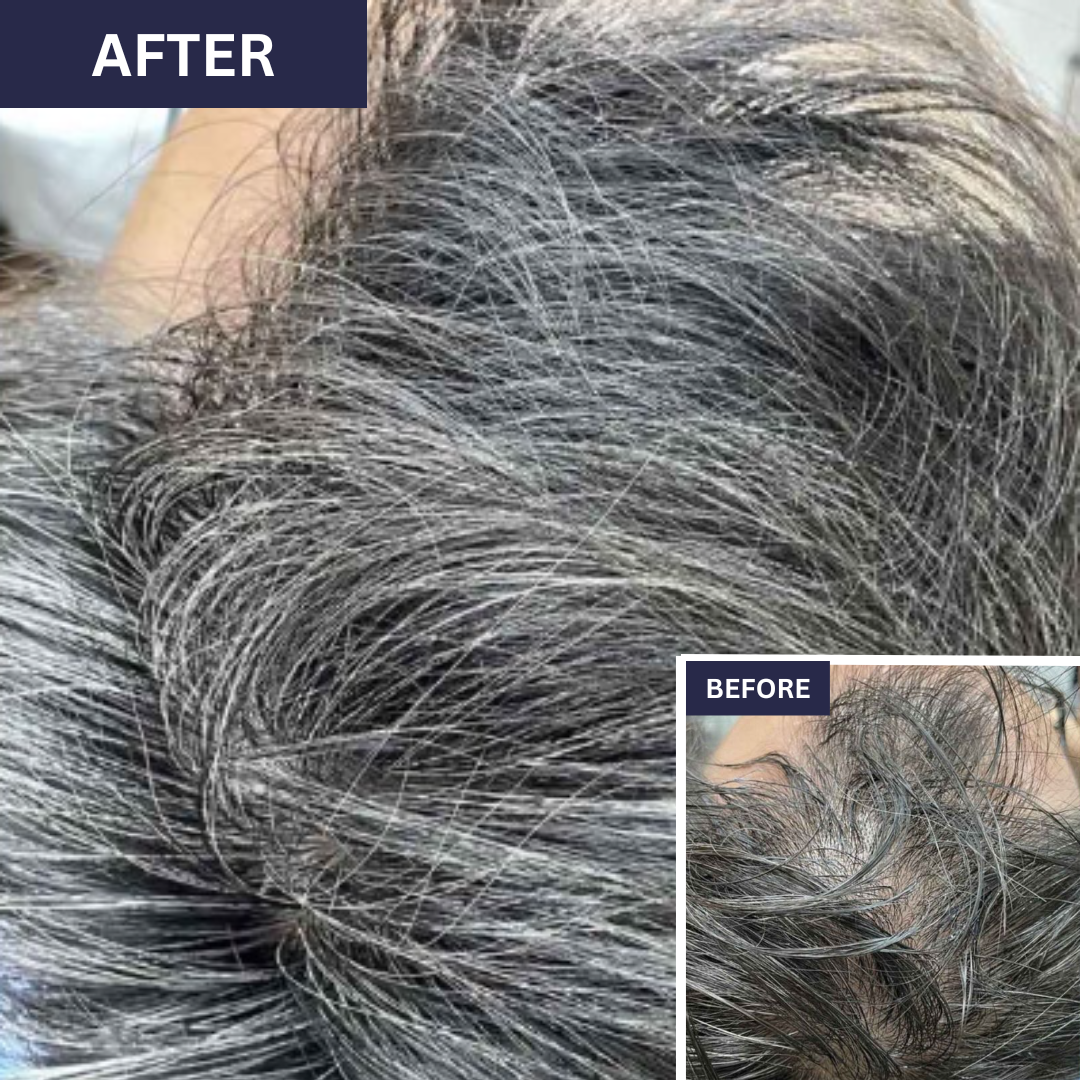 Calecim Advanced Hair System Kit