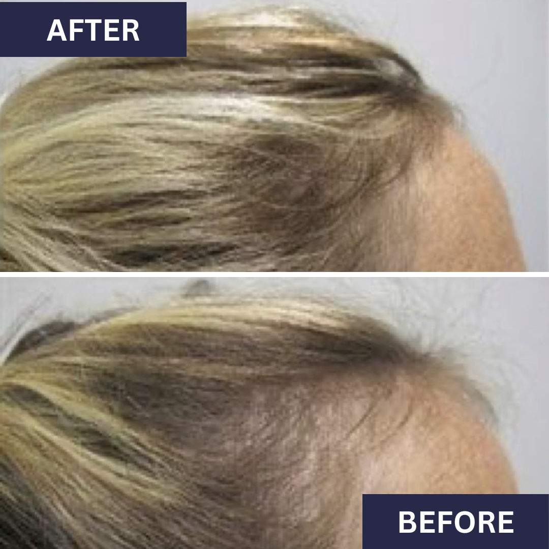 Calecim Advanced Hair System Kit
