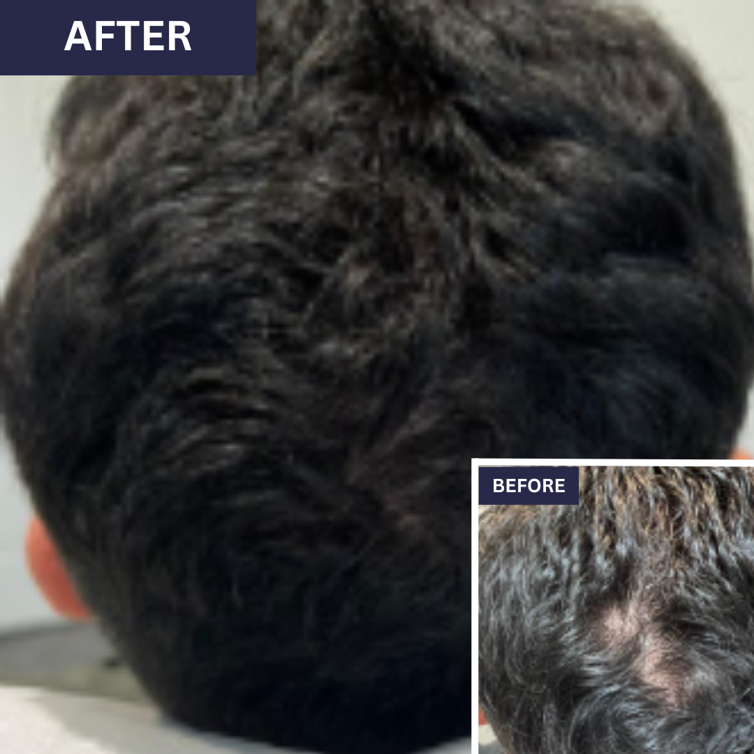 Calecim Advanced Hair System Kit