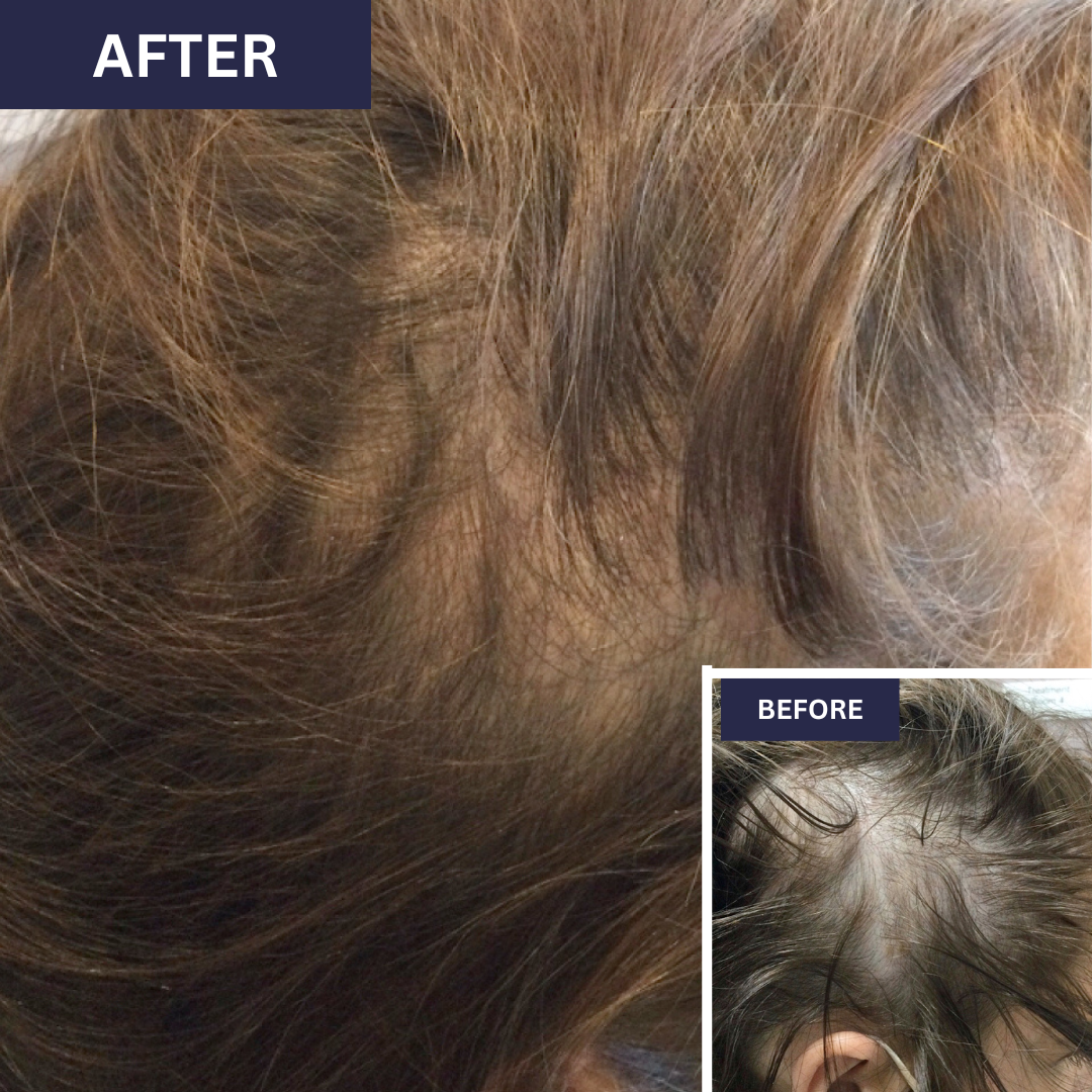 Calecim Advanced Hair System Kit